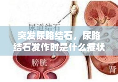 突發(fā)尿路結(jié)石，尿路結(jié)石發(fā)作時是什么癥狀? 