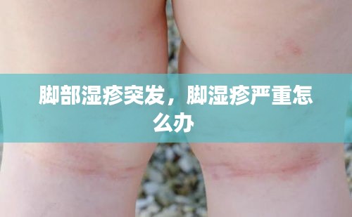 腳部濕疹突發(fā)，腳濕疹嚴重怎么辦 