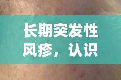 長期突發(fā)性風(fēng)疹，認(rèn)識、預(yù)防與治療全攻略